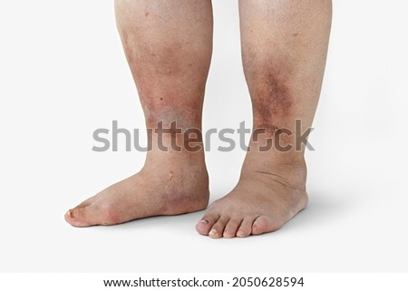 Inflamed legs of a woman with diabetes, close-up	