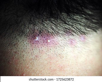 Inflamed Pus Pimples On Head Scalp Stock Photo 1725623872 | Shutterstock