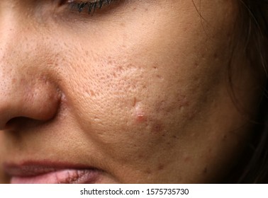 Inflamed Skin On The Face. Acne. Pimples On The Skin. Scars And Peeling.