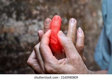 Inflammation Of Asian Old Man Middle Finger And Hand. Concept Of Cellulitis And Finger Problems.