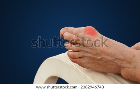  inflammation of the big toe bone. Hallux valgus, bunion in foot on dark blue  background.