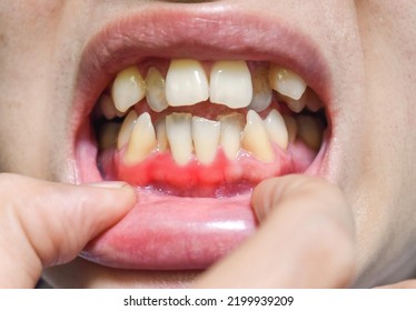 Inflammation Of Gum Called Gingivitis. Periodontal Problem. Poor Oral Hygiene.