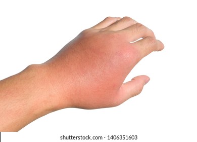 Inflammation, Swelling, Redness Of The Hand Shows Infection.
Insect Bites. Cellulitis At Left Hand Isolated On White Background.