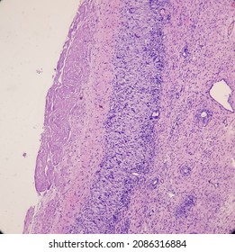 Inflammatory Breast Lump, Chronic Nonspecific Mastitis With Fibrocystic Changes And Ductal Hyperplasia, No Malignant Cell.