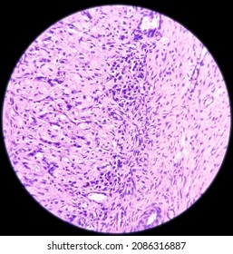 Inflammatory Breast Lump, Chronic Nonspecific Mastitis With Fibrocystic Changes And Ductal Hyperplasia, No Malignant Cell.