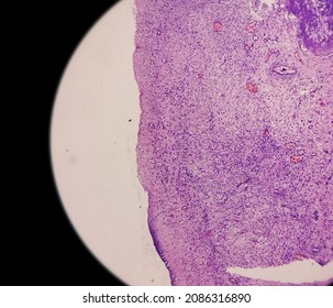 Inflammatory Breast Lump, Chronic Nonspecific Mastitis With Fibrocystic Changes And Ductal Hyperplasia, No Malignant Cell.