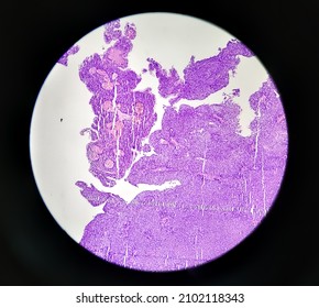 Inflammatory Breast Lump, Chronic Nonspecific Mastitis With Fibrocystic Changes And Ductal Hyperplasia, No Malignant Cell.