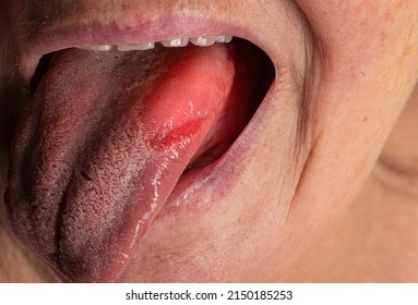 Inflammatory disease in the tongue. Red spot, glossitis. Hygiene of the tongue