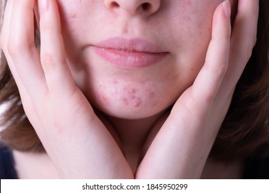 inflammatory and severe acne on the chin of a teenage girl in close-up - Shutterstock ID 1845950299