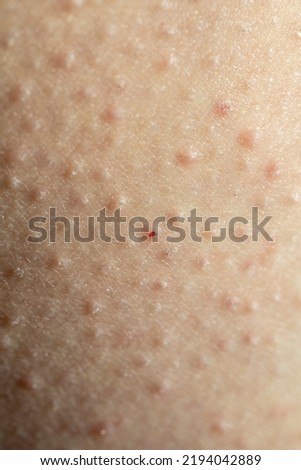 Ingrown Hairs, Keratosis Pilaris, Folliculitis or strawberry legs close-up on a caucasian skin. Irritated human skin due to epilation. Selective focus, vertical shot
