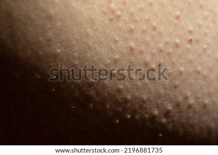 Ingrown Hairs, Keratosis Pilaris, Folliculitis or strawberry legs close-up on a caucasian skin. Irritated human skin due to epilation. Selective focus