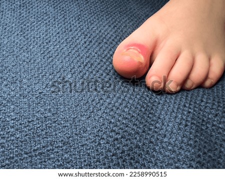 Ingrown nail or onychocryptosis concept. Foot of scandinavian child with red spot on big toe.