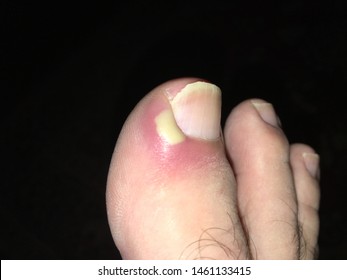 Ingrown Toe Nail With Infection