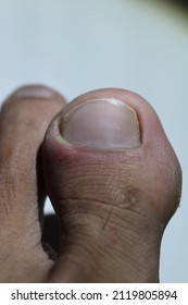 Ingrown Toenail On Man's Foot, Pain In Big Toe Closeup