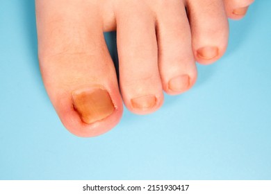 Ingrown Toenail Problem. Infected Foot Check. Podiatry Patient. Treats ingrown nail. Concept body care. injured toenail in, close up banner image on blue background. Nail problem - Shutterstock ID 2151930417