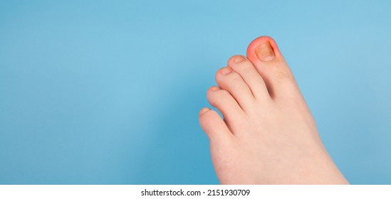 Ingrown Toenail Problem. Infected Foot Check. Podiatry Patient. Treats ingrown nail. Concept body care. injured toenail in, close up banner image on blue background. Nail problem - Shutterstock ID 2151930709