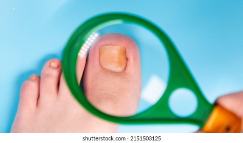 Ingrown Toenail Problem. Infected Patient Foot Check. Doctor examinating of injured toenail  through magnifying glass in clinic. Closeup. Diagnosis, treatment of mycosis of feet. Inflammation of toes - Shutterstock ID 2151503125