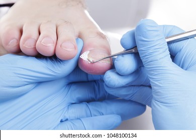 Ingrown Toenail Procedure Toe Nail Dressing Stock Photo 1048100134 ...