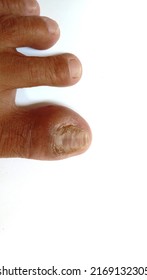 Ingrown Toenails, Isolated On White Background, Pain In The Big Toe Closeup