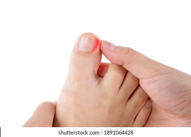 Ingrown toenails on a woman's foot, isolated on white background, pain in the big toe closeup - Shutterstock ID 1891064428