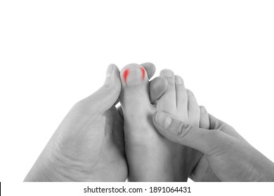 Ingrown Toenails On A Woman's Foot, Isolated On White Background, Pain In The Big Toe Closeup