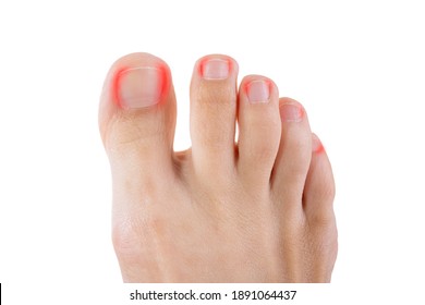 Ingrown Toenails On A Woman's Foot, Isolated On White Background, Pain In The Big Toe Closeup