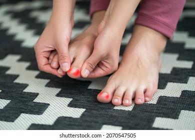 Ingrown Toenails On A Woman's Foot, Pain In The Big Toe Closeup