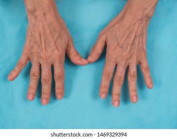 Inicial Change Rheumatoid Arthritis Ulnar Deviation Stock Photo ...