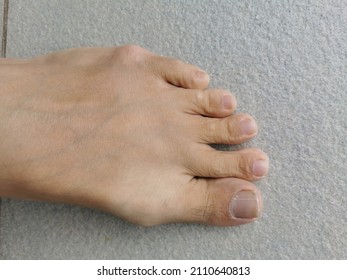 Initial Signs Of Tailor's Bunion Foot Deformity 