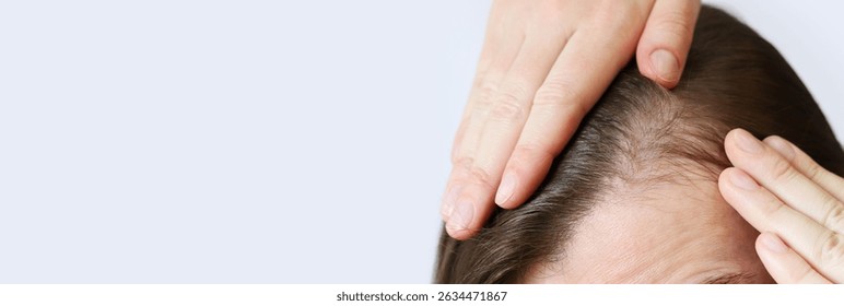 Initial stage of baldness, close-up. Young woman showing bald spots on forehead and temples. Hair loss, alopecia. Concept of hair problems and their treatment. Hair care. Close-up of bald spots