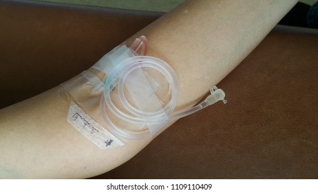 Injection Needle And Iv Tube On Patien Arm.