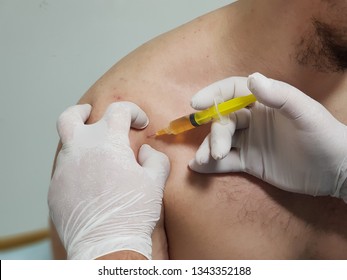 Injection Prp In The Shoulder Joint. The Hands Of The Doctor With A Syringe.