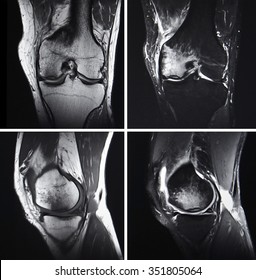 Injured Knee, MRI