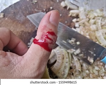 Injured Thumb With Bleeding Open Cut. Fresh Wound On The Thumb Finger. 