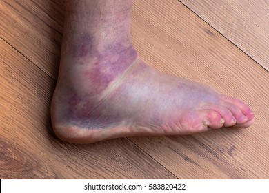 injury ankle, swollen foot