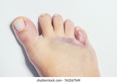 Hematoma Stock Images, Royalty-Free Images & Vectors | Shutterstock