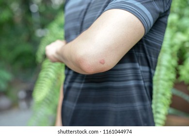 An Insect Bite Mark On A Man’s Arm With Copy Space