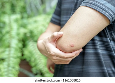 An Insect Bite Mark On A Man’s Arm With Copy Space