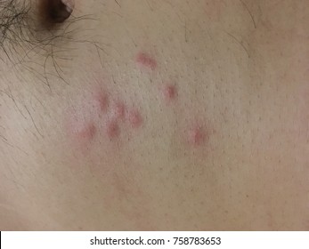 Insect bite skin
