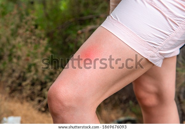 Insect bite on a woman\'s leg. A woman\
was bitten by an insect, a large red insect bite mark. outdoors in\
the forest. concept of protection from insect\
bites