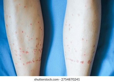 Insect Bites Causing Red Bumps on Legs from Black Flies in Summer Outdoors Close-Up Photography in Natural Light