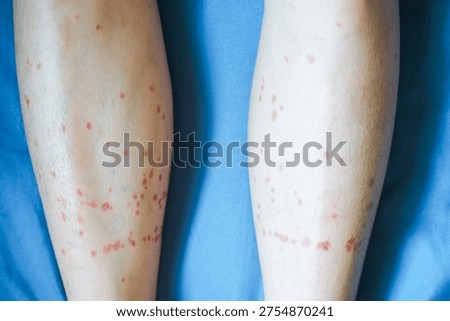 Insect Bites Causing Red Bumps on Legs from Black Flies in Summer Outdoors Close-Up Photography in Natural Light