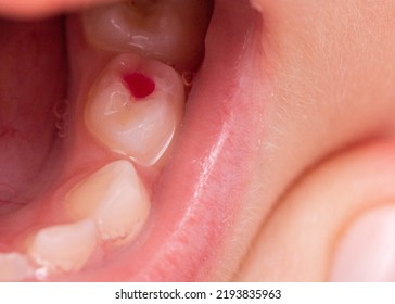 Installation Of A Colored Red Filling In A Milk Tooth For A Child. Colored Fillings In Dentistry For Children. Treatment Of Pulpitis And Deep Caries