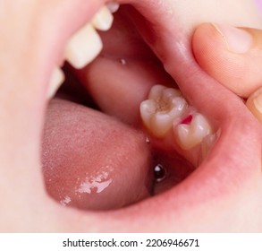 Installation Of A Colored Red Filling In A Milk Tooth For A Child. Colored Fillings In Dentistry For Children. Treatment Of Pulpitis And Deep Caries