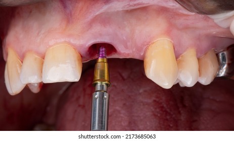 installation of a dental abutment after implantation of the central tooth - Shutterstock ID 2173685063