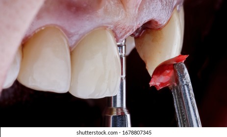 Instruments And Bone Tissue Before Dental Implantation