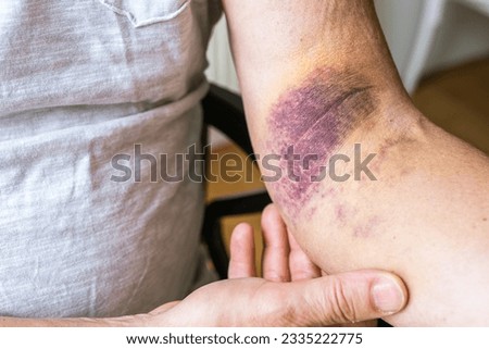 Intense bruising from dislocated elbow joint, ligament damage on man, muscle, ligament sprain in sports, inflammation, injury. Bruise, bruise, veins, blood vessels, close-up on injured arm muscular 