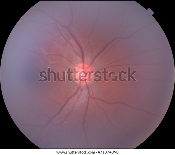 Interior Surface Eye Including Retina Retinal Stock Photo