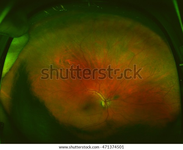 Interior Surface Eye Including Retina Retinal Stock Photo