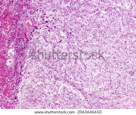 Intermediate lobe or pars intermedia of a human pituitary showing some cysts and nest of basophilic cells that extend towards the posterior lobe (right). It is the so-called basophilic invasion